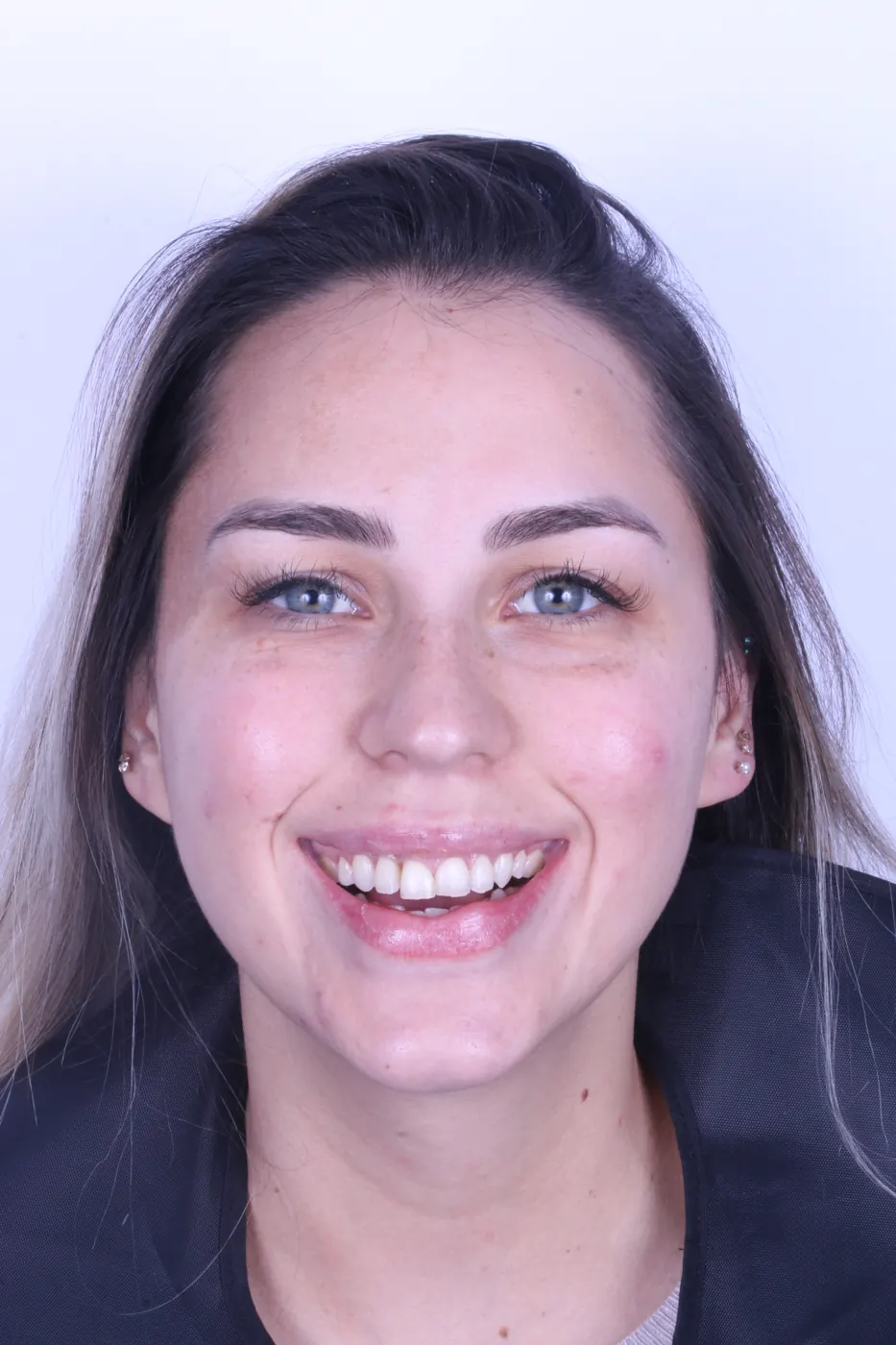 Ceramic smile design — before